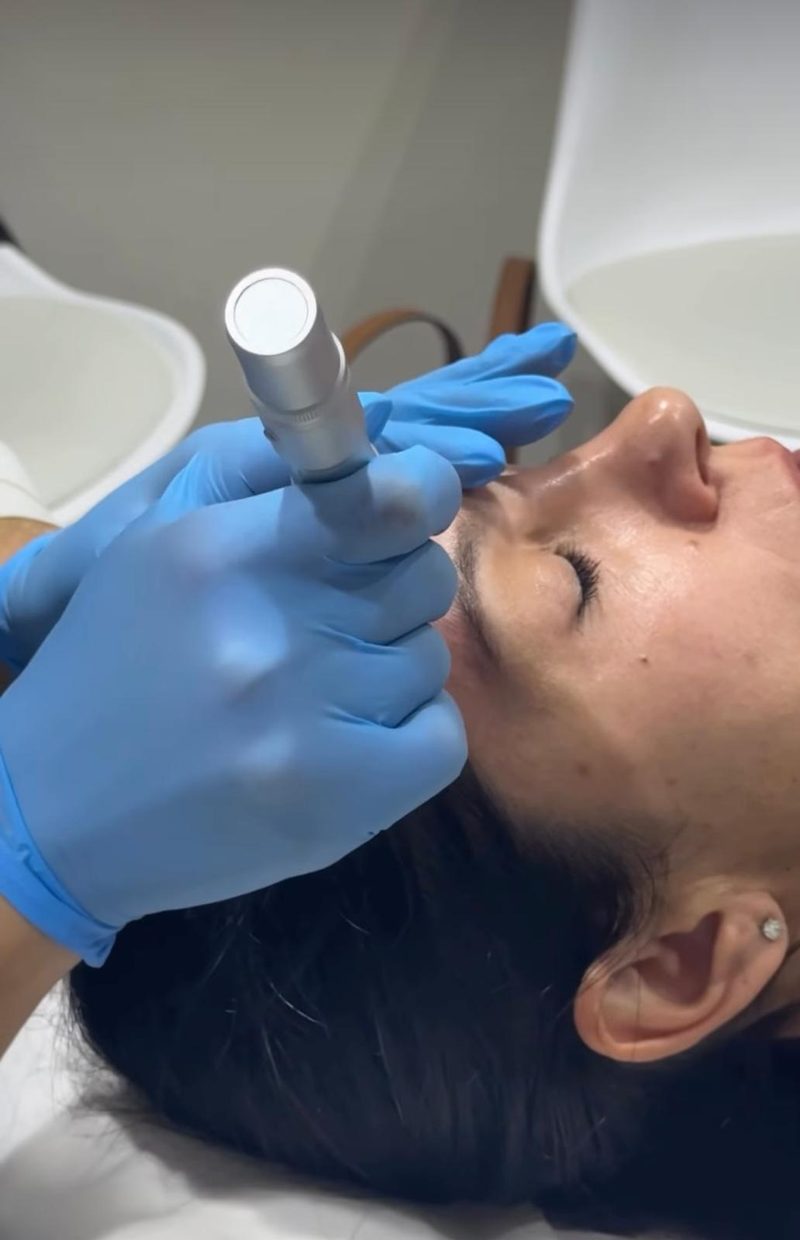 Dermapen · Microneedling en ValeriCare Sabadell